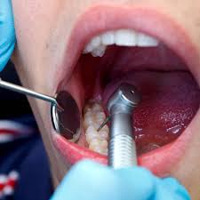 Access Cavity Restoration